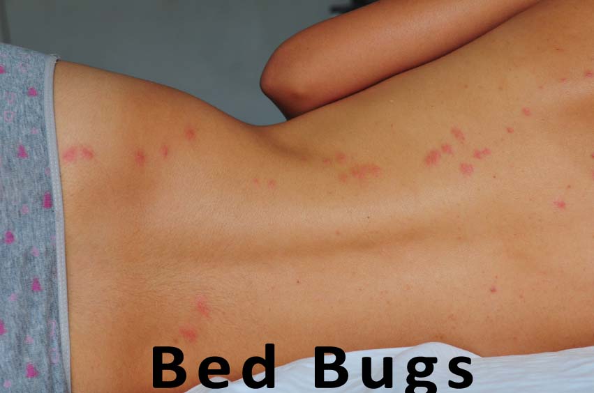 Bed bugs bites